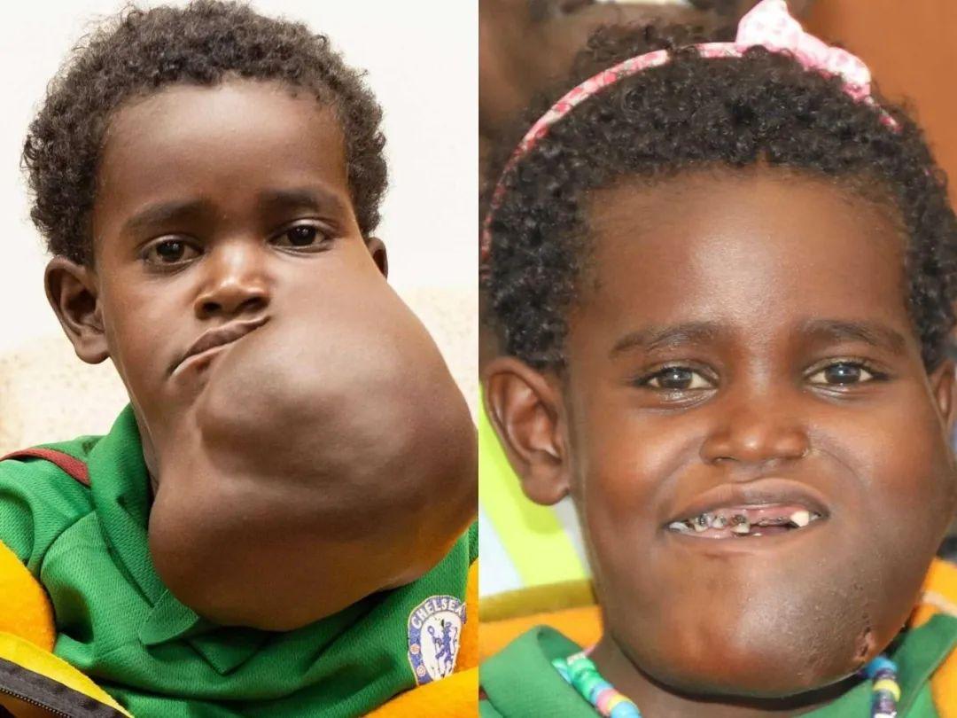 埃塞俄比亚女孩脸上长蜜瓜大小瘤子，好心医生无偿摘除